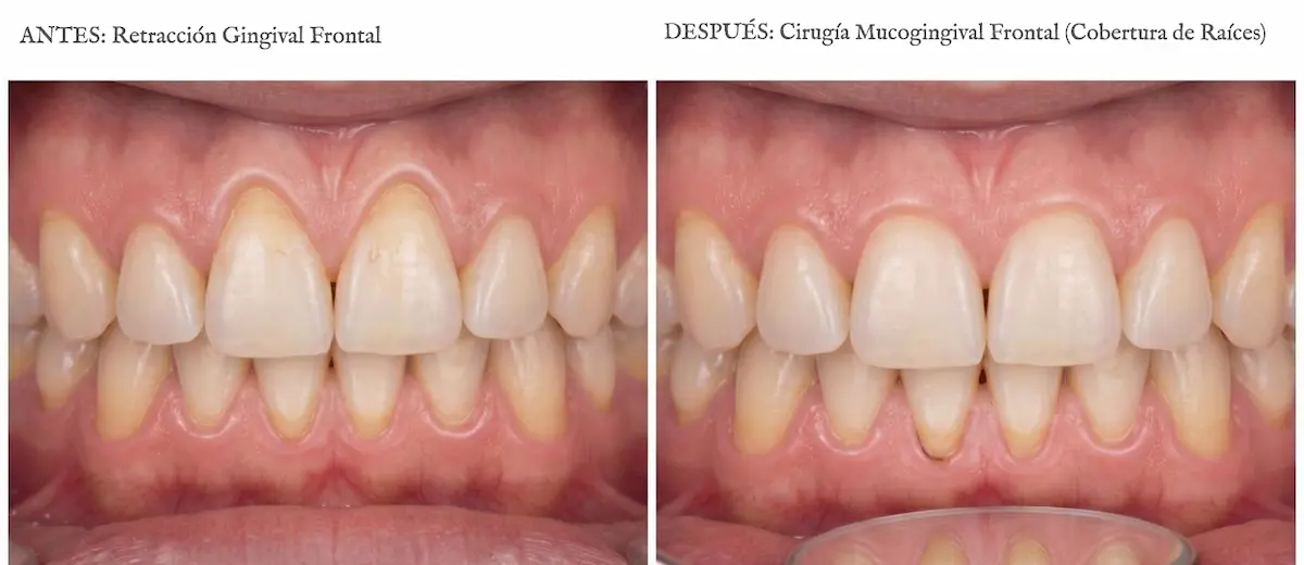 Antes y después de cirugía mucogingival