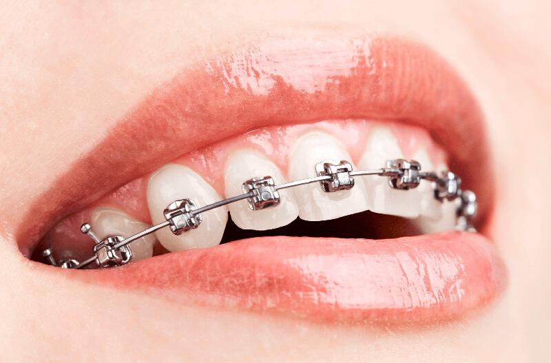 dentalkiub Brackets Convencionales